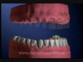 Implante Dental 3
