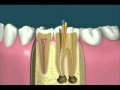 Tratamiento de endodoncia