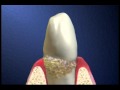 Limpieza dental integral